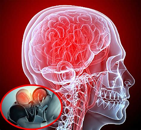 Cerebral edema is a severe complication of stroke linked to glymphatic system malfunction ...