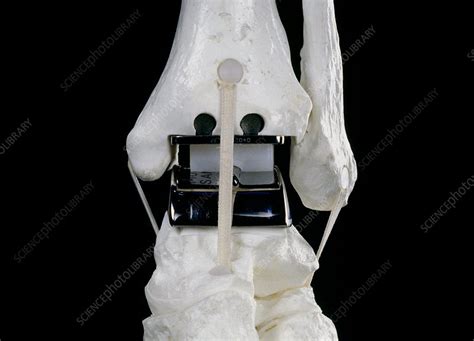 Replacement ankle joint - Stock Image - C003/6330 - Science Photo Library