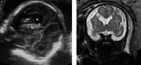 Schizencephaly Ultrasound