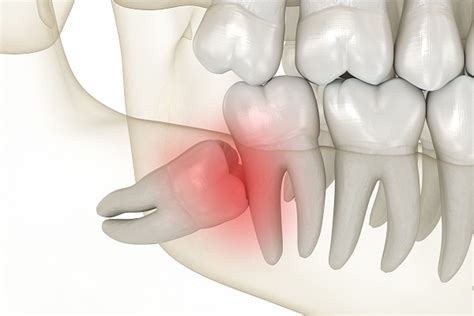 When to Consider Wisdom Tooth Removal