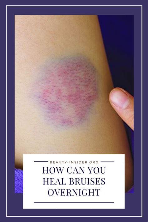 How Can You Heal Bruises Overnight in 2020 | Heal bruises, Bruises remedy, Body healing