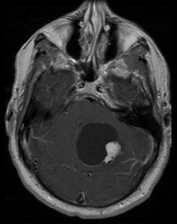 Dr. Arun L.Naik - Hemangioblastoma