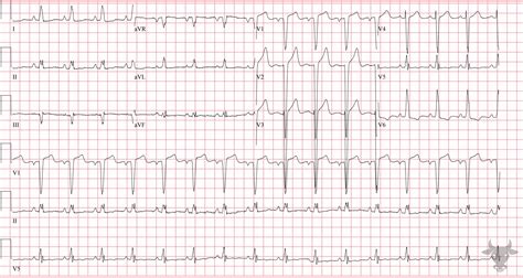 Left Ventricular Hypertrophy | ECG Stampede