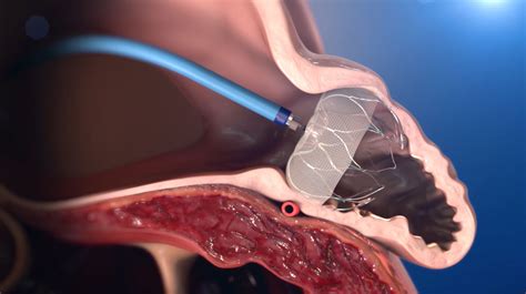 Watchman | CardioVascular Afib Procedure