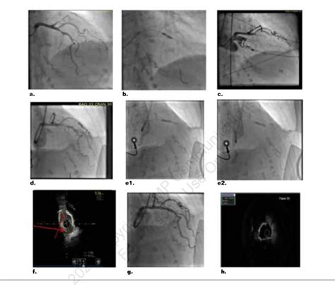 Coronary angiography. | Download Scientific Diagram