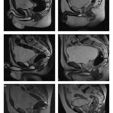 MRI images showing spheric and cone bladder shapes. | Download Scientific Diagram