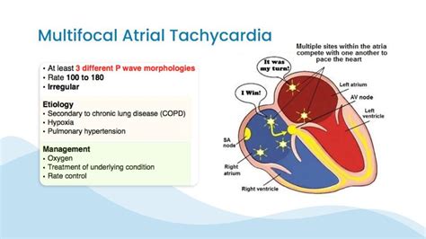 Overview of Multifocal Atrial Tachycardia (MAT) ECG