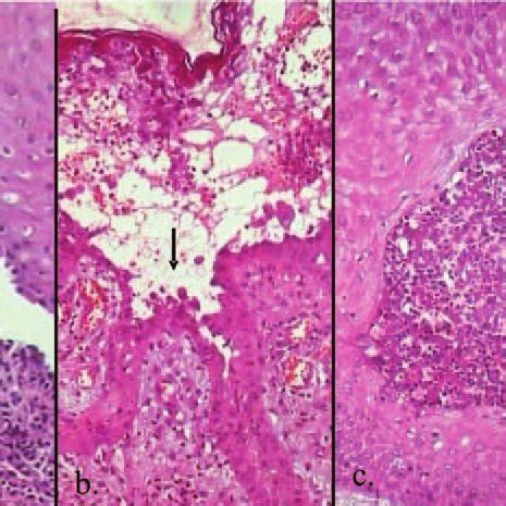 -Light microscopy a. suprabasal cleft in the oral mucosa. b. suprabasal... | Download Scientific ...