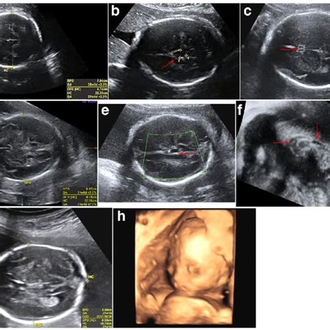 Bpd In Ultrasound Means In Hindi - adrenalinewoman