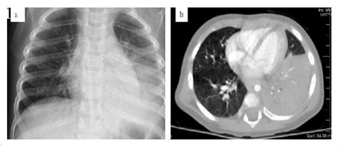 The chest imagings of the case 2. (a) Lobar consolidation and pleural ...