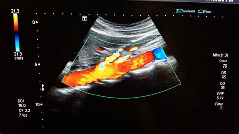 aortasagcolorprox | Abdominal aorta, Sonography, Ultrasound