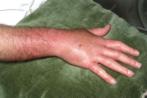 Inflammation due to cellulitis on a man's hand - Stock Image M130/0286 ...