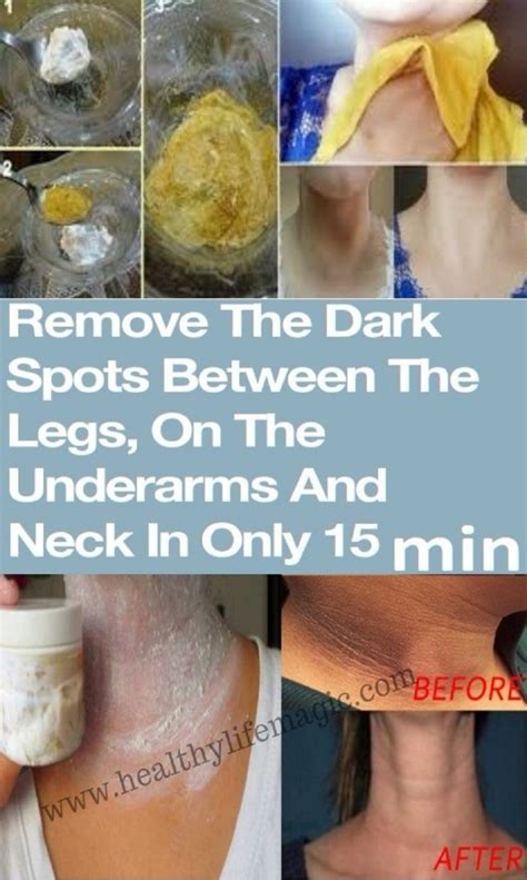 REMOVE THE DARK SPOTS BETWEEN THE LEGS, ON THE UNDERARMS AND NECK IN ...