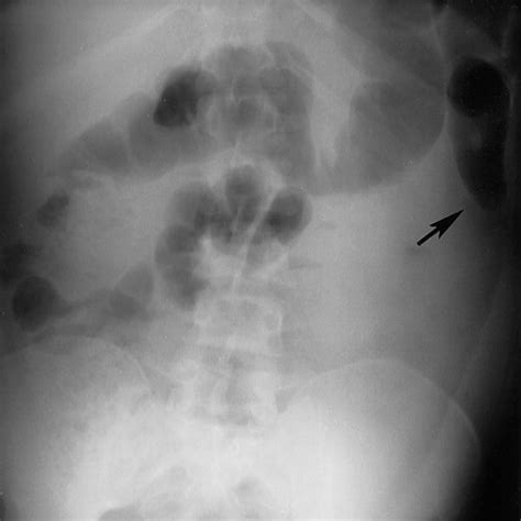 Sentinel Loop Sign In Acute Pancreatitis - In acute pancreatitis, the ...