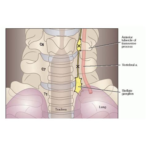 extraer insondable Cadena stellate ganglion block cinta África agujero