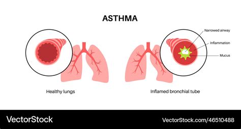 Asthma lung disease Royalty Free Vector Image - VectorStock