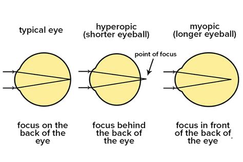 What Is the Definition of High Myopia (Severe Nearsightedness)?