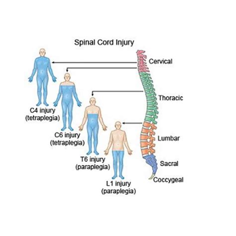 Spinal Cord Injury Attorneys - Brown & Crouppen Law Firm