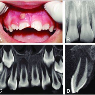 Immature maxillary right central incisor (#8) showing pulp necrosis and ...