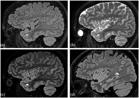 Brain Mri Scan 3d