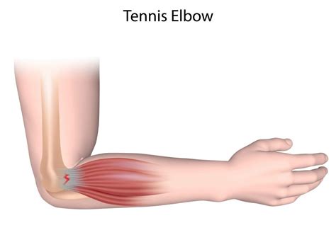 Tennis elbow - Move Osteopathy