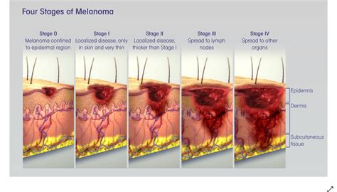 Catching Skin Cancer Early | Boomers Daily