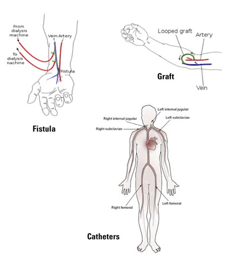 In Center Dialysis « Centers for Dialysis Care - Quality Care and so ...