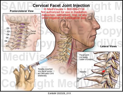 Cervical Facet Joint Injection Medical Illustration Medivisuals