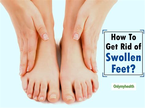 Home Remedies To Treat Swollen Ankles And Feet | OnlyMyHealth