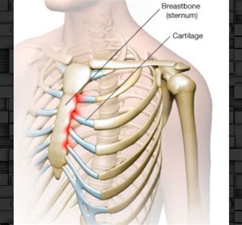 Pin on Inflammation of the chest muscles