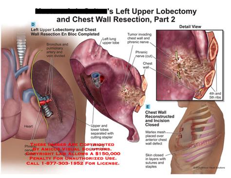 Upper Lobectomy and Chest Wall Resection, Part 2