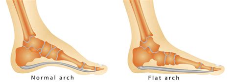 Fallen Arches: Symptoms, Causes, Exercises, Treatment, Diagnosis