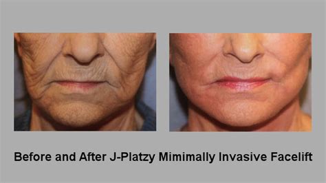 Before and After J-Plasma, J-Platzy minimally invasive face lift FF - LookYounger.News