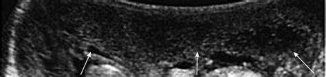 US of the scrotum in a 5-year-old boy with acute painless scrotal ...