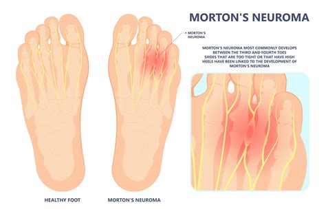 Neuromas/Morton’s Neuroma | Nova Family Podiatry