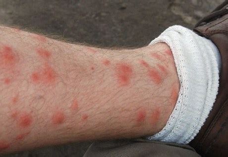 what causes rash on legs - pictures, photos