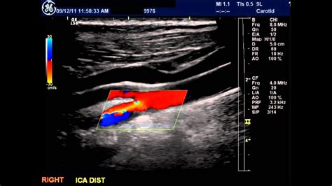 how long can you live with 100 blocked carotid artery - Mike Browder