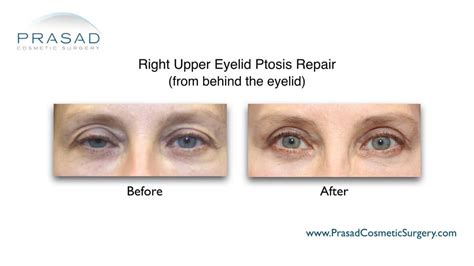 Eyelid Ptosis Causes - Possible Neurological Causes | Dr. Prasad