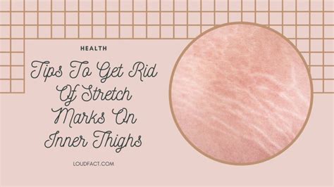 How To Get Rid Of Stretch Marks On Inner Thighs: Proven Tips - LoudFact