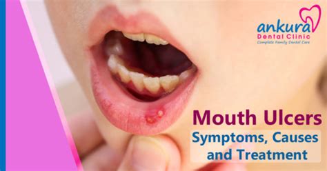 Difference Between Mouth Cancer and Mouth Ulcer