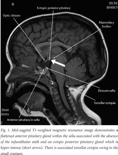 Pituitary Stalk