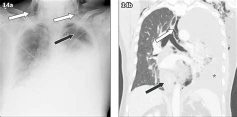 Oesophageal tear in a 51-year-old man presenting to the emergency ...