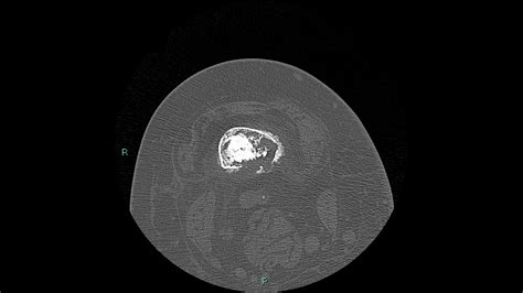 Chondrosarcoma CT - wikidoc