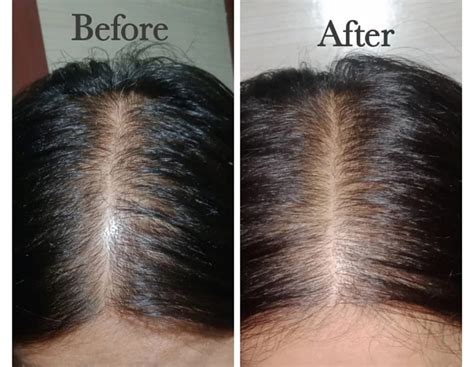 Rosemary Oil for Hair Growth Before and After Results: Here's What to