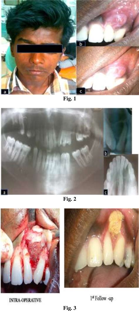 Figure 3 from Globulomaxillary Cyst in a 16 year old male patient-A ...