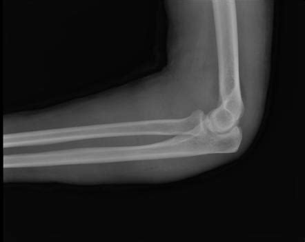 Coronoid process fracture | Radiology Case | Radiopaedia.org