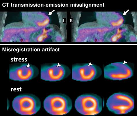 Cardiac PET/CT for the Evaluation of Known or Suspected Coronary Artery ...