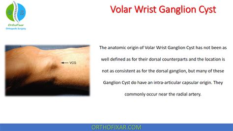 Volar Ganglion Cyst In The Wrist | OrthoFixar 2025