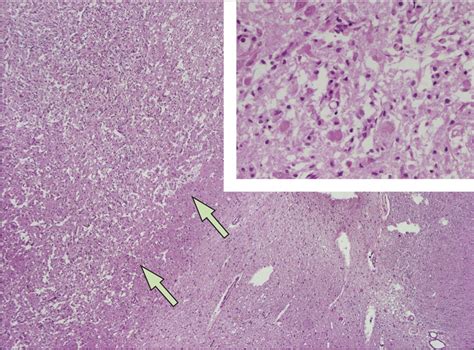 Wernicke's encephalopathy: new clinical settings and recent advances in ...