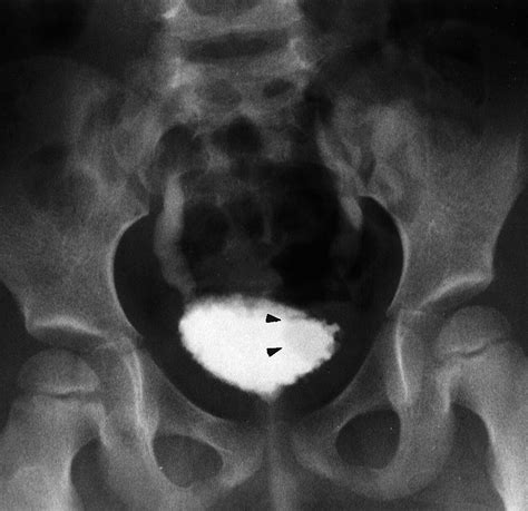 Pediatric Voiding Cystourethrography: A Pictorial Guide | RadioGraphics